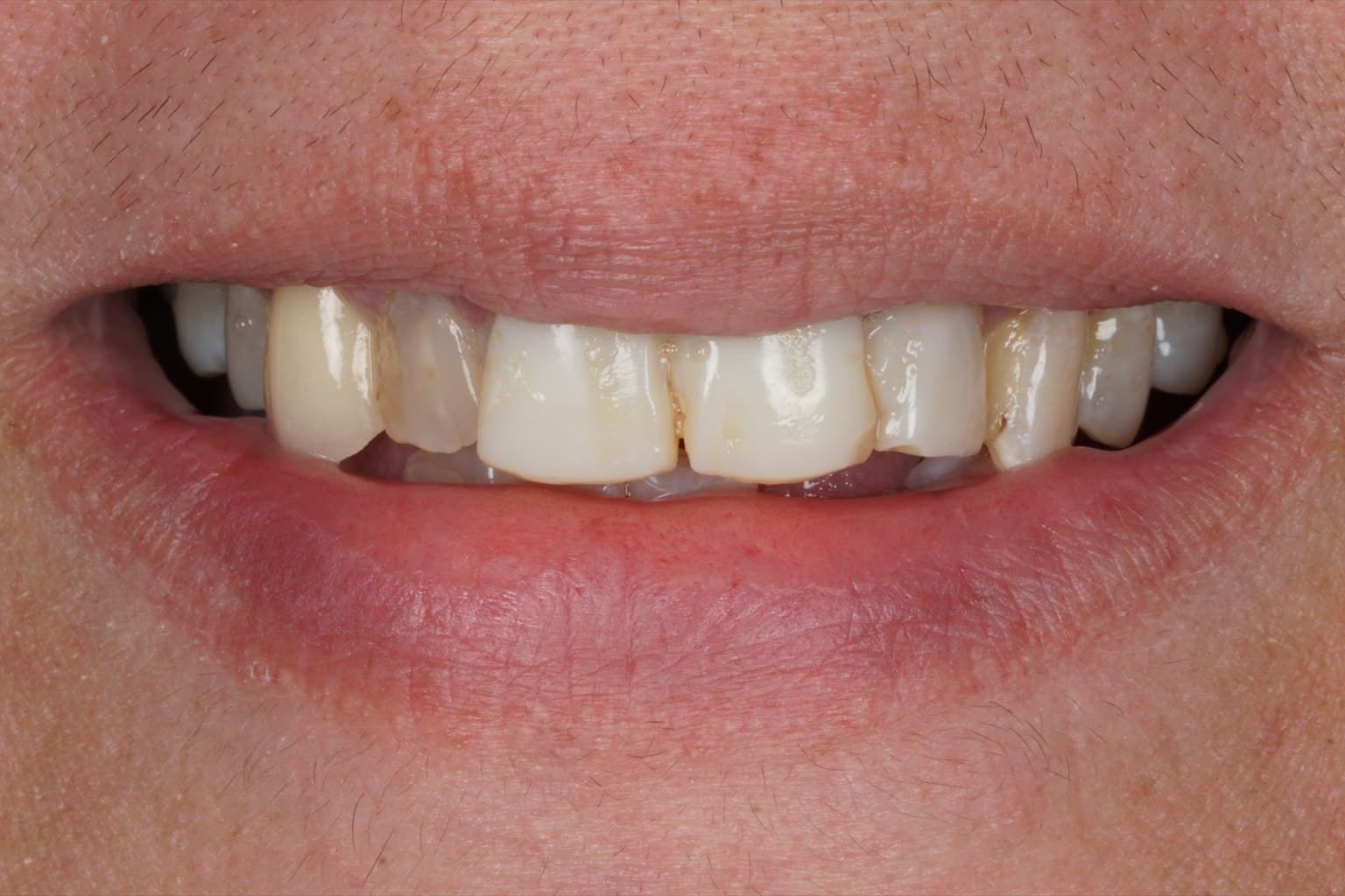 Patient's initial smile before a virtual veneer simulation