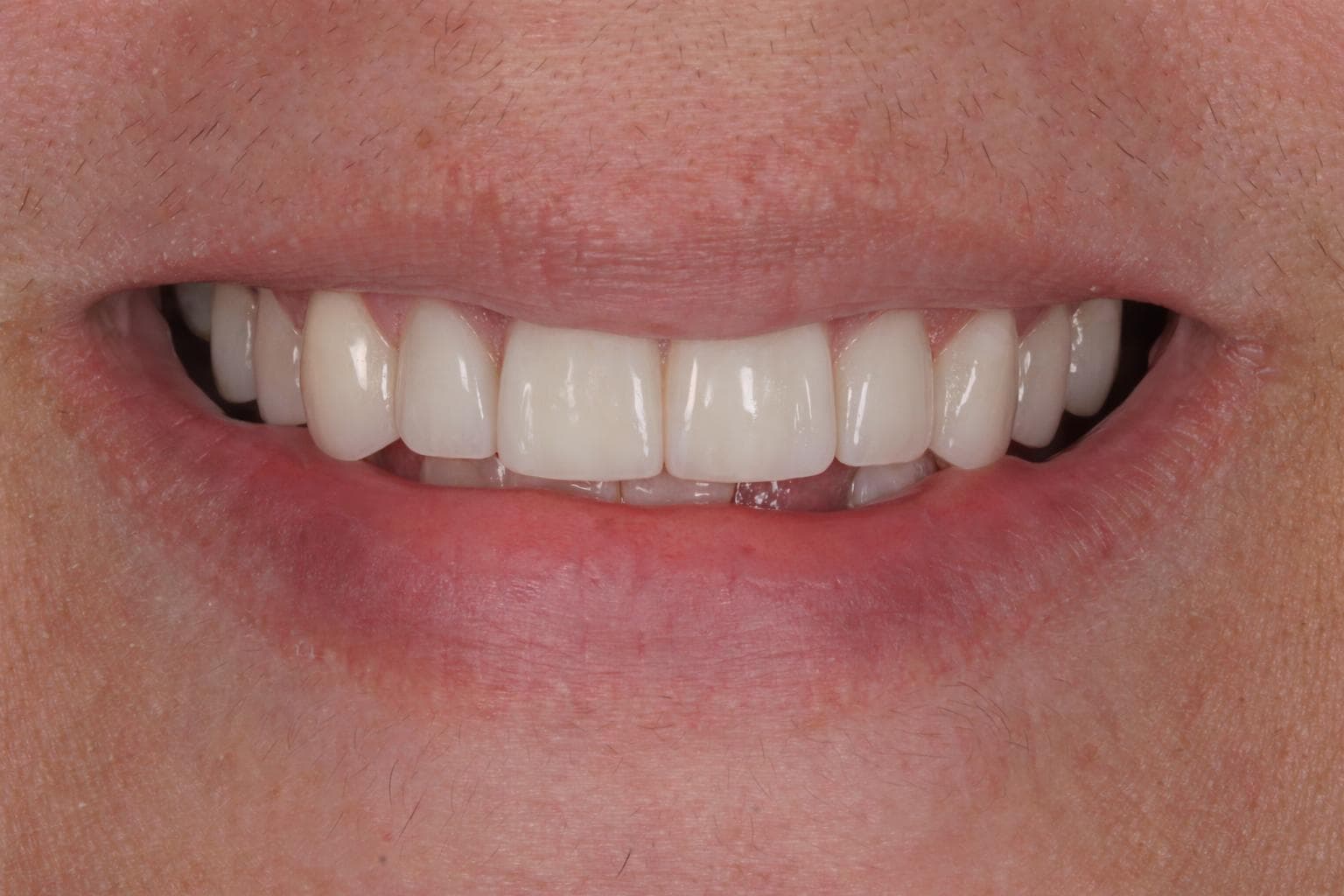 Virtual veneer smile simulation preview for the same patient