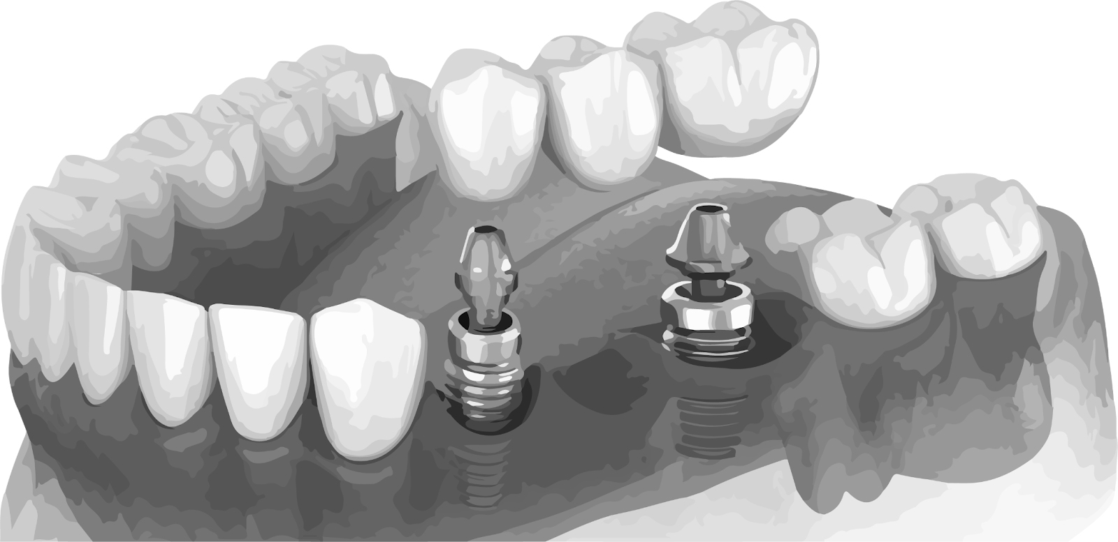 A picture of a Implant-Supported Bridge